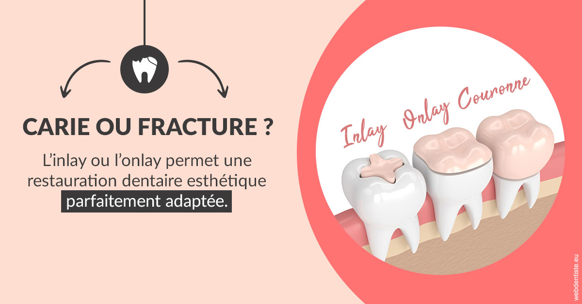 https://www.dentiste-neuville.fr/T2 2023 - Carie ou fracture 2