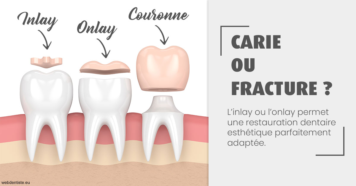 https://www.dentiste-neuville.fr/T2 2023 - Carie ou fracture 1