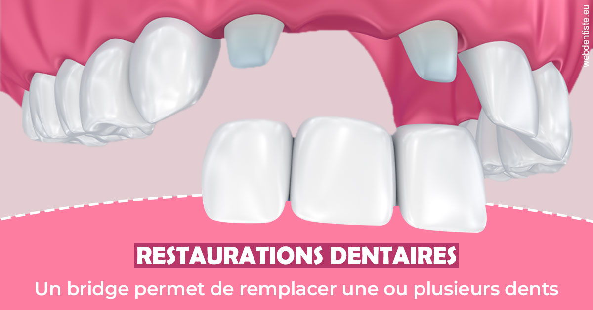 https://www.dentiste-neuville.fr/Bridge remplacer dents 2