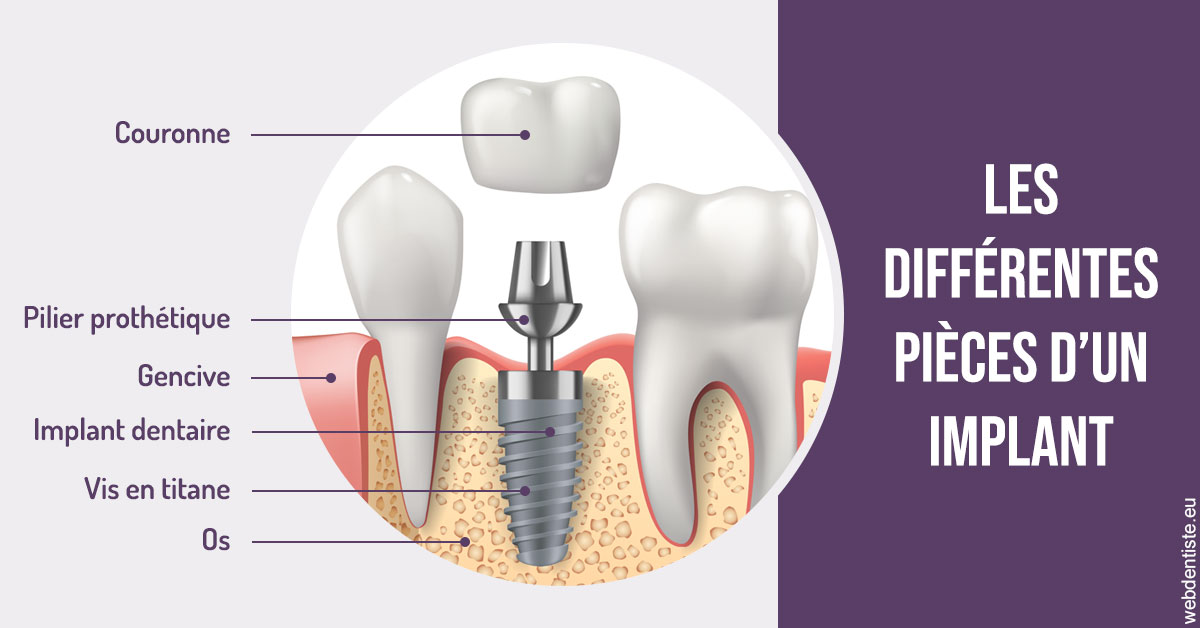 https://www.dentiste-neuville.fr/Les différentes pièces d’un implant 2