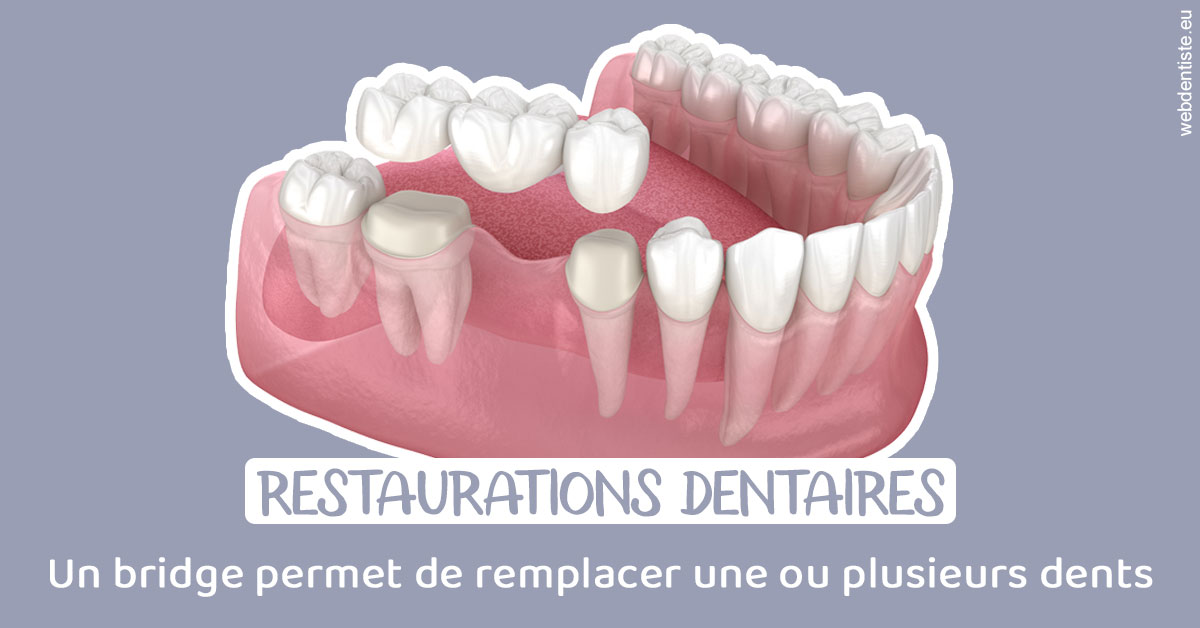 https://www.dentiste-neuville.fr/Bridge remplacer dents 1