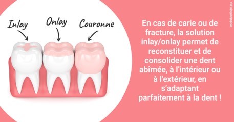 https://www.dentiste-neuville.fr/L'INLAY ou l'ONLAY 2