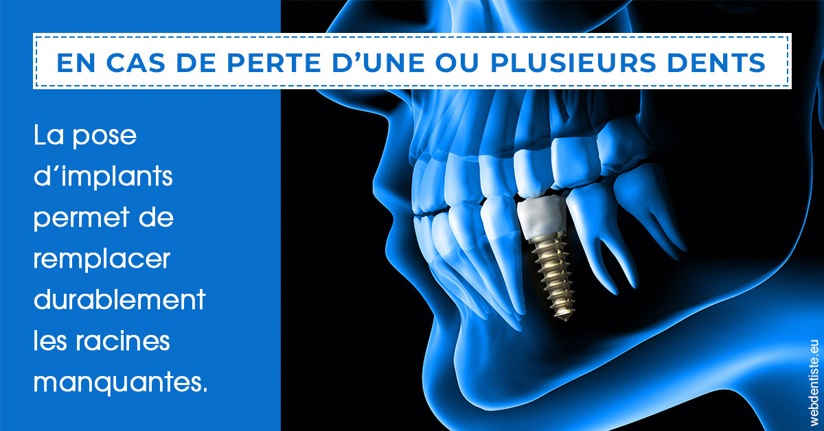 https://www.dentiste-neuville.fr/2024 T1 - Implants 01